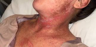 EXCLUSIV: Mărturiile femeii ajunse la ATI din cauza cremei vândute de Ancuța Cîrcu – „Ea făcea live-uri când eu mă zbăteam între viață și moarte”