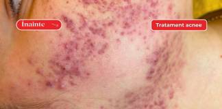 Acneea la adolescenți, mai mult decât o problemă estetică. Tratament dermatologic personalizat, la Clinica ALTEO din Bistrița!