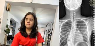 Maria, o tânără cu sindromul Down, are nevoie urgentă de o operație de scolioză care costă 50.000 de euro. Ajutăm?